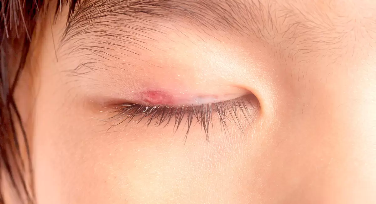 سرطان پوست پلک چشم